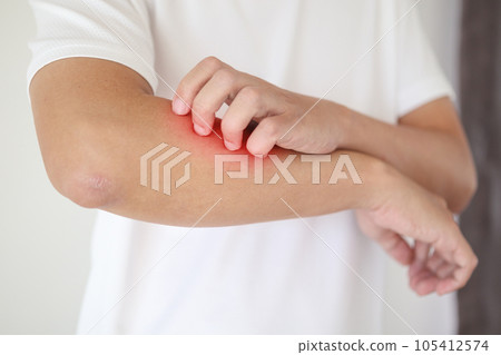 man itching and scratching on arm from itchy dry skin eczema dermatitis 105412574