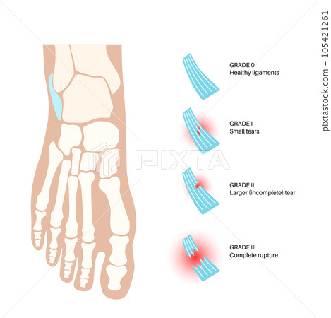 Sprained ankle injury Sprained ankle injury 105421261