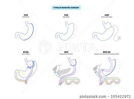 Bariatric surgery poster 105422972