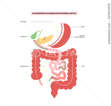 Biliopancreatic diversion procedure 105422976