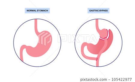 Gastric bypass surgery 105422977