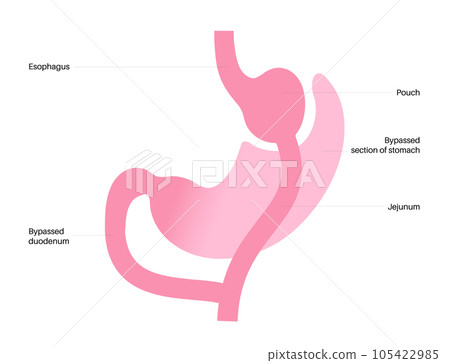 Gastric bypass surgery Gastric bypass surgery 105422985
