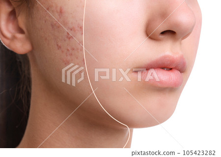 Teenage girl before and after acne treatment on white background, closeup 105423282
