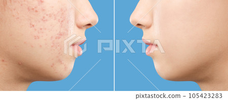 Teenage girl before and after acne treatment on blue background, closeup 105423283