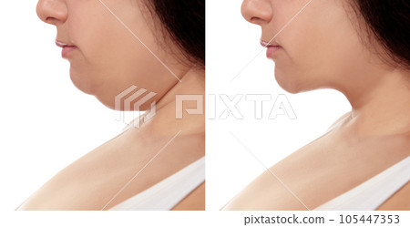 Woman before and after plastic surgery operation on white background, closeup. Double chin problem Woman before and after plastic surgery operation on white background, closeup. Double chin problem 105447353