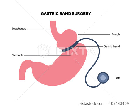 Gastric band poster Gastric band poster 105448409