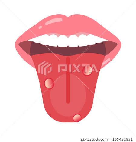 tongue with stomatitis 105451851