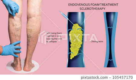 Endovenous laser treatment for varicose veins - foam sclerotherap concept. 105457170