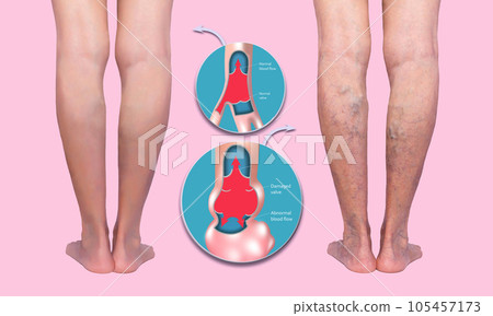 Varicose veins on a female senior legs. The structure of normal and varicose veins. 105457173