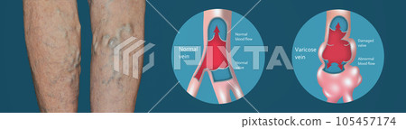 Varicose veins on a female senior legs. The structure of normal and varicose veins. Varicose veins on a female senior legs. The structure of normal and varicose veins. 105457174