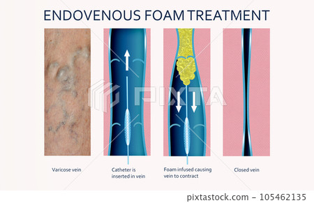Endovenous laser treatment for varicose veins - foam sclerotherapy concept. Endovenous laser treatment for varicose veins - foam sclerotherapy concept. 105462135
