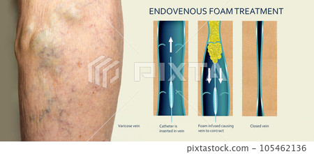Endovenous laser treatment for varicose veins - foam sclerotherapy concept. Endovenous laser treatment for varicose veins - foam sclerotherapy concept. 105462136