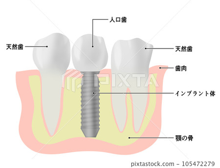 種植牙和天然牙的插圖 105472279