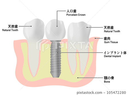 種植牙和天然牙的插圖 種植牙和天然牙的插圖 105472280