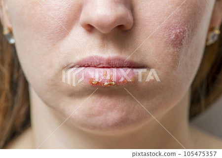 Close up of female lips affected by herpes virus. Close up of female lips affected by herpes virus. 105475357