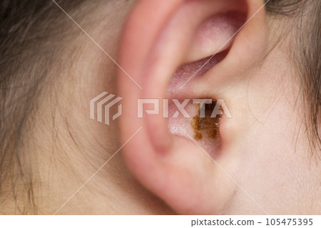 Earwax in the dirty ear of child. Hole ear of human, wax on hair and skin of ear Earwax in the dirty ear of child. Hole ear of human, wax on hair and skin of ear 105475395