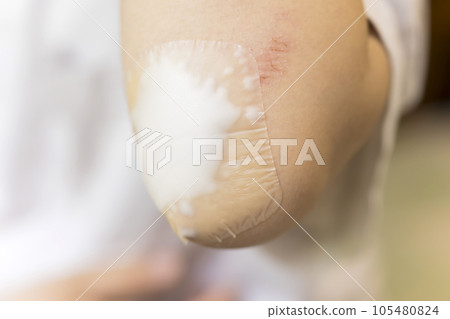 A child applying a moist pad to a wound on his elbow Kizu Power Pad A child applying a moist pad to a wound on his elbow Kizu Power Pad 105480824