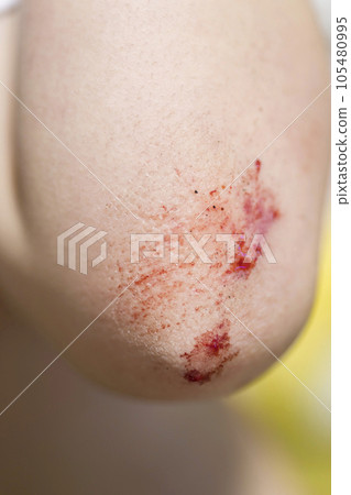 Child's elbow abrasion image 105480995