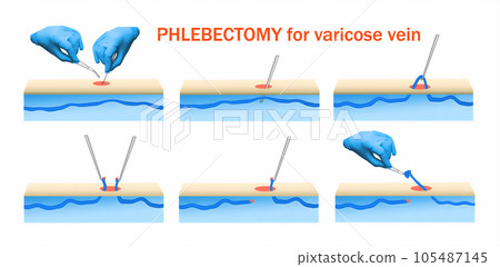 Ambulatory Phlebectomy Treatment for varicose vein. 105487145
