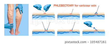 Ambulatory Phlebectomy Treatment for varicose vein. Ambulatory Phlebectomy Treatment for varicose vein. 105487161