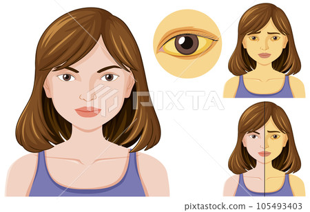 Jaundice disease vector concept 105493403