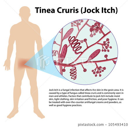 Trichophyton Rubrum fungal infection 105493410