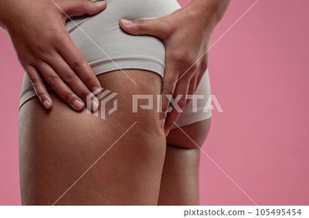 Close up of woman checking her legs on cellulitis 105495454