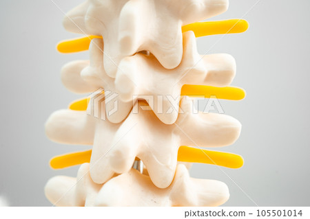 Lumbar spine displaced herniated disc fragment, spinal nerve and bone. Model for treatment medical in the orthopedic department. Lumbar spine displaced herniated disc fragment, spinal nerve and bone. Model for treatment medical in the orthopedic department. 105501014