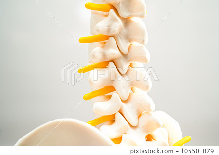 Lumbar spine displaced herniated disc fragment, spinal nerve and bone. Model for treatment medical in the orthopedic department. Lumbar spine displaced herniated disc fragment, spinal nerve and bone. Model for treatment medical in the orthopedic department. 105501079