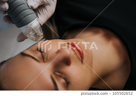 Microneedle RF lifting procedure. Hardware cosmetology. 105502652