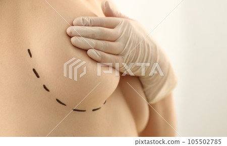 Female breast marked for plastic surgery in clinic 105502785