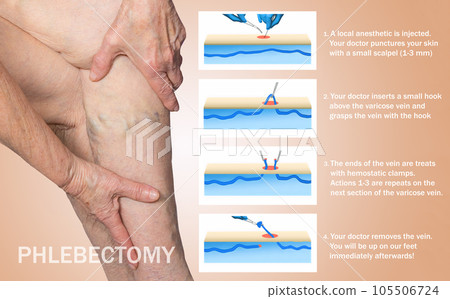 Ambulatory Phlebectomy Treatment for varicose vein. 105506724