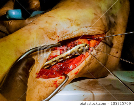 In case of leg fracture, treatment may involve surgical implantation of metal plate. 105515709