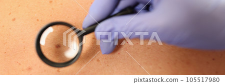 Gloved doctor dermatologist with magnifying glass examines skin of patient. Gloved doctor dermatologist with magnifying glass examines skin of patient. 105517980