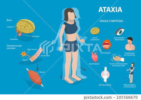 3D Isometric Flat Vector Conceptual Illustration of Ataxia 105566670