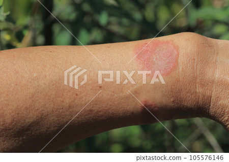 毛毛蟲咬痕 = 之後 105576146