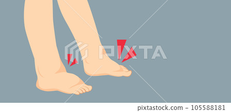 Swelling Feet Or Kidney Problems Illustration Swelling Feet Or Kidney Problems Illustration 105588181