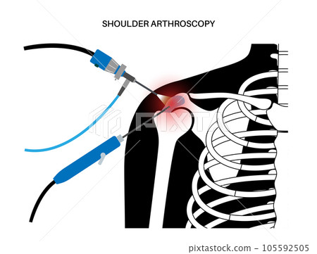 Shoulder arthroscopy poster 105592505