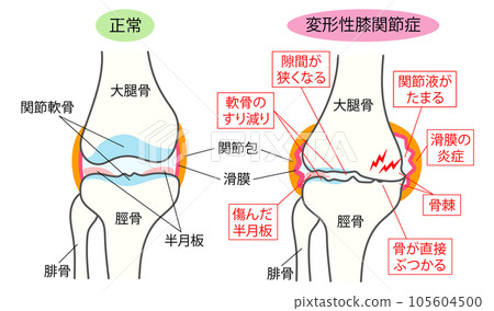 Comparison explanatory illustration of normal knee joint and osteoarthritis of the knee Comparison explanatory illustration of normal knee joint and osteoarthritis of the knee 105604500