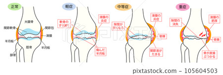 Comparison explanation illustration of normal knee joint and osteoarthritis of the knee joint by progression 105604503