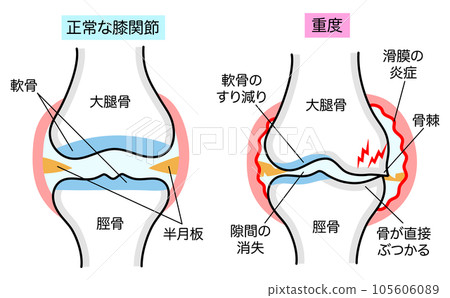 正常膝關節與膝骨關節炎的簡單解釋比較圖 105606089