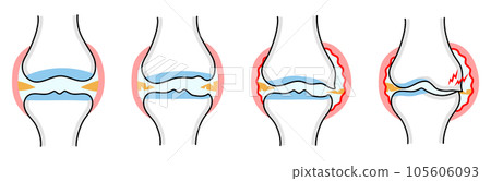 Simple illustration of knee osteoarthritis by progression Simple illustration of knee osteoarthritis by progression 105606093