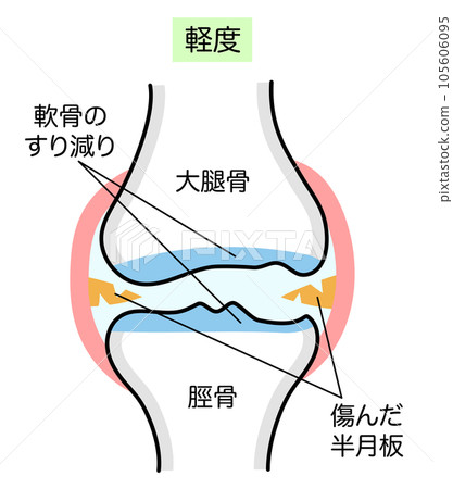 輕度膝骨關節炎的簡單說明 105606095