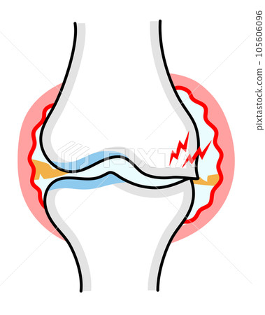 嚴重膝骨關節炎的簡單說明 105606096