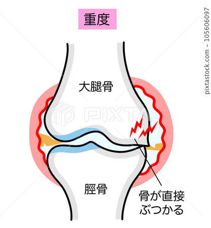 嚴重膝骨關節炎的簡單說明圖 105606097