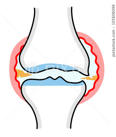 中度膝骨關節炎的簡單說明 105606098