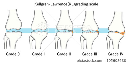 Illustration of the Kellgren-Lawrence Classification of Knee Osteoarthritis 105608688
