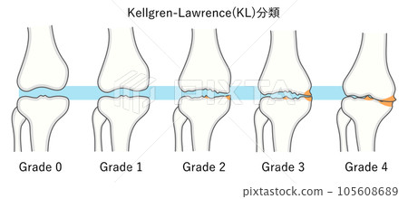 Illustration of the Kellgren Lawrence Classification of Knee Osteoarthritis 105608689