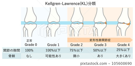 Illustration of progression of knee osteoarthritis (KL classification) 105608690