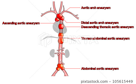 Simple aorta schematic from neck to waist 105615449